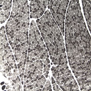 maladies neuromusculaires en Bretagne
