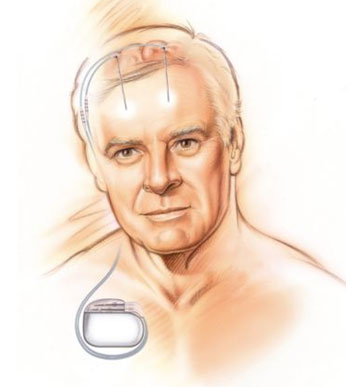 Figure 3. Schéma du dispositif de stimulation cérébrale profonde.