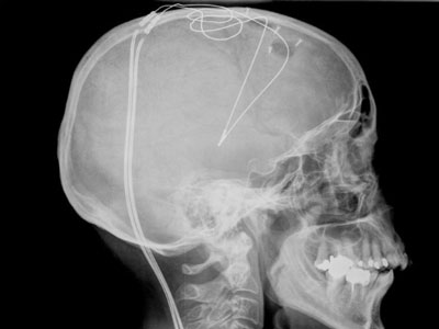 Figure 4. Radiographie de contrôle post-opératoire des électrodes chroniques implantées de manière bilatérale dans le noyau subthalamique.