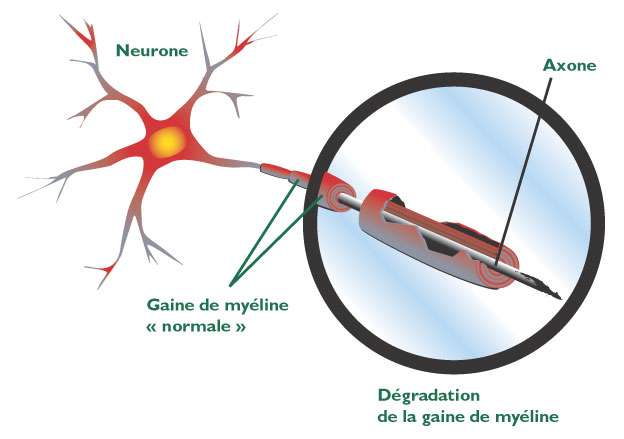 Qu'est ce que la sclérose en plaques ? – INCR Institut des ...
