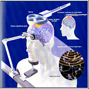 La stimulation magnétique transcranienne