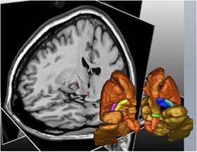 Optimisation et compréhension de la stimulation cérébrale profonde