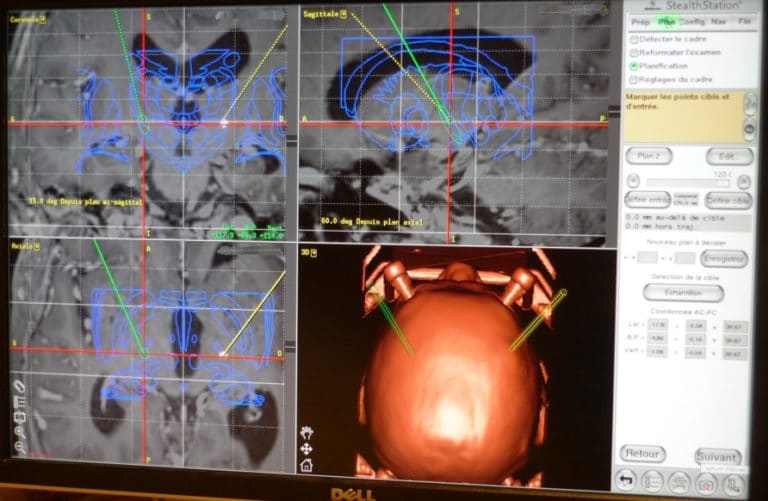 Opération de stimulation cérébrale profonde information du patient